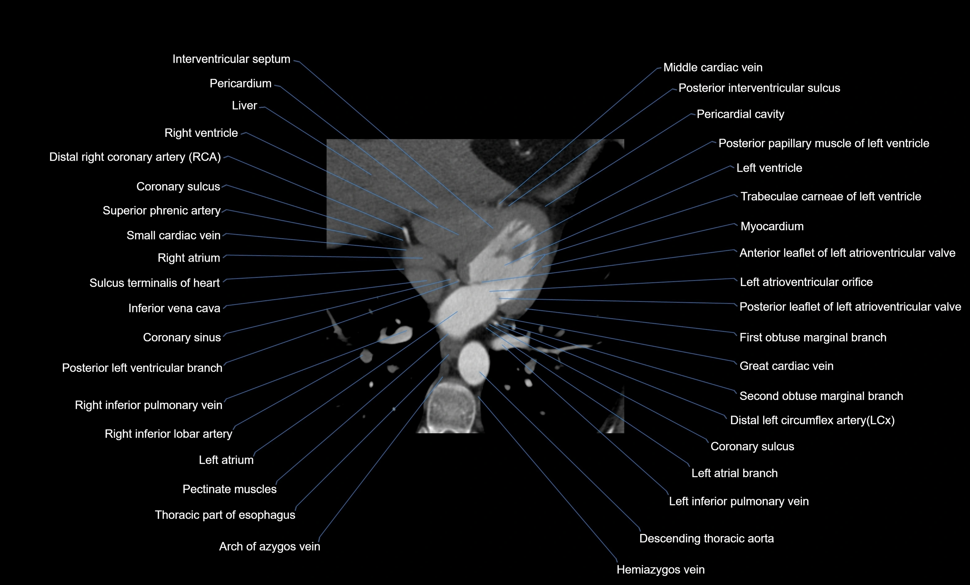 CT heart (coronary angiogram) four chamber view  cross sectional anatomy labelled radiology image -00036.webp